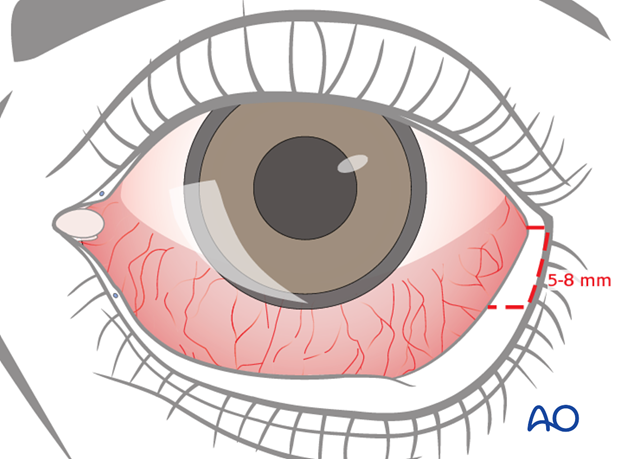 lower eyelid lateral strip canthopexy