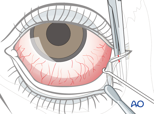 lower eyelid lateral strip canthopexy
