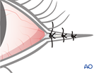 irreversible paralysis eye complex