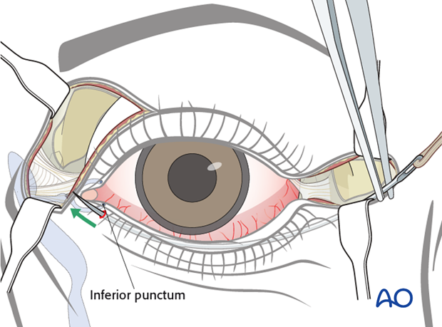 lower eyelid tendon sling