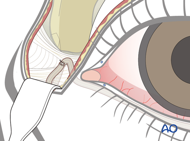lower eyelid tendon sling