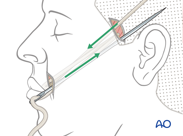 static suspension with tendons