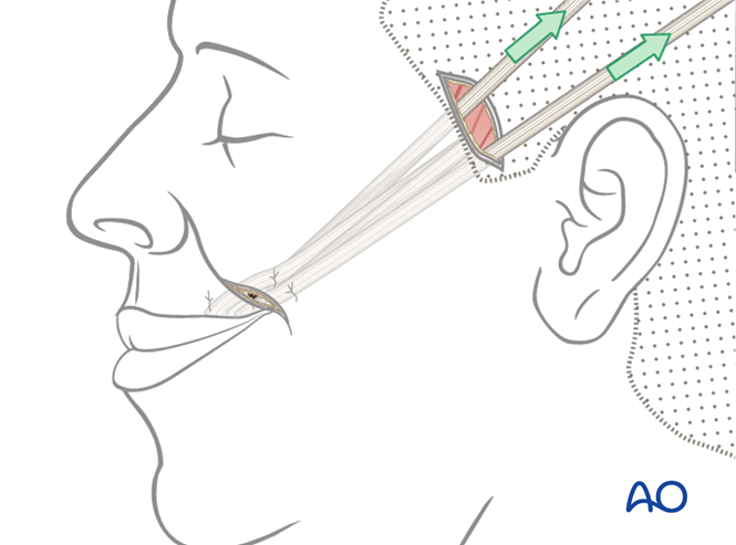 Static suspension with tendons for Irreversible paralysis, midface and ...