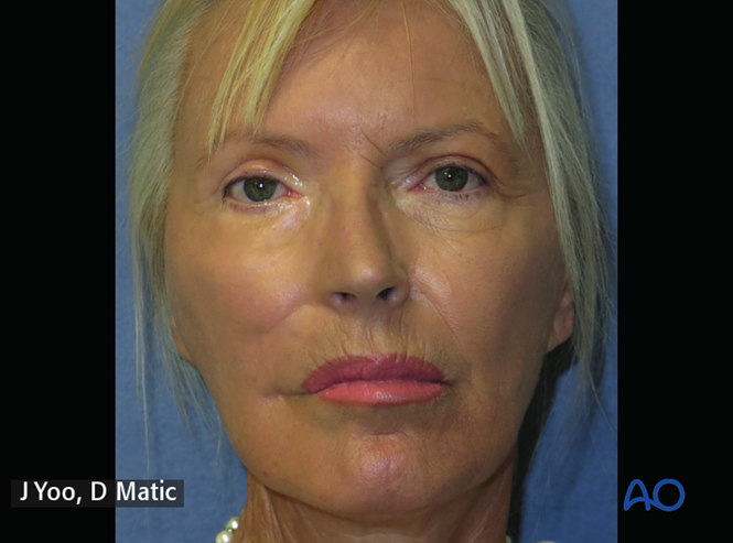 Static suspension with tendons for Irreversible paralysis, midface and ...