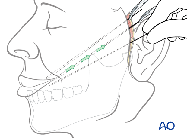 masseter muscle transposition