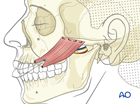 irreversible paralysis midface and mouth