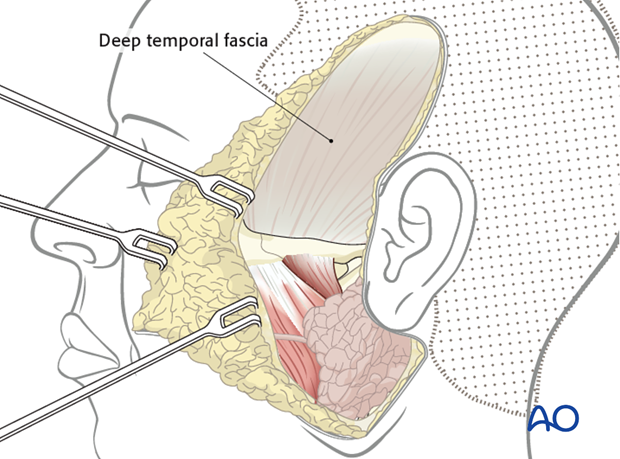 temporalis muscle antidromic mini sling