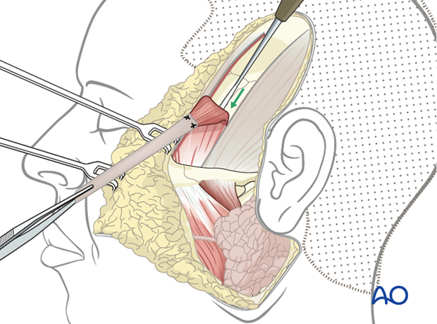 temporalis muscle antidromic mini sling