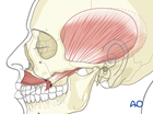 irreversible paralysis midface and mouth