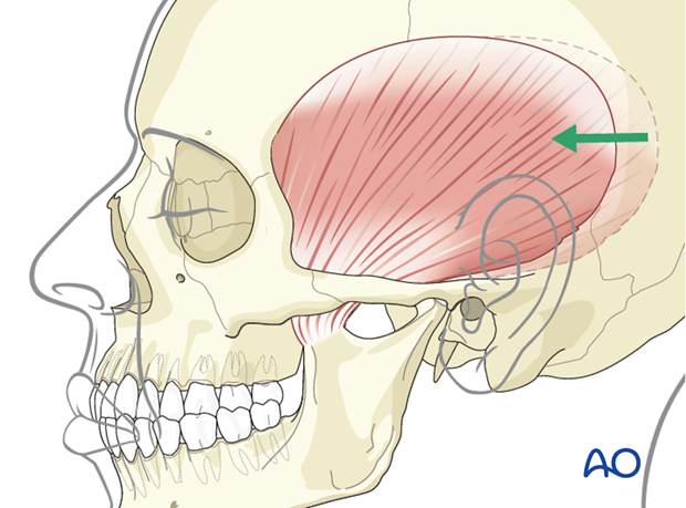 temporalis muscle transposition