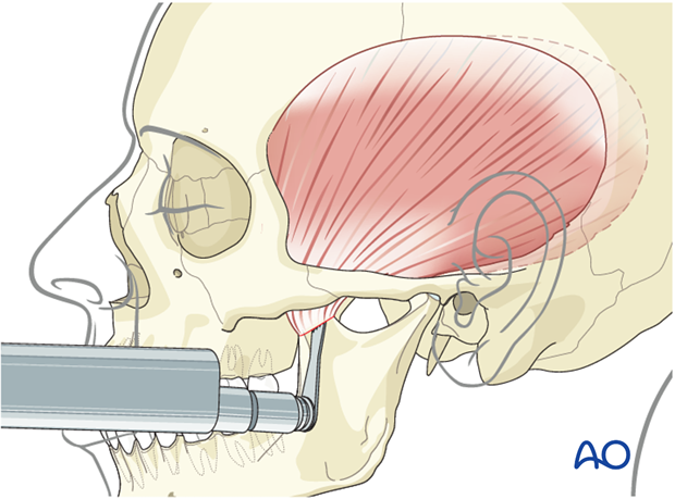 temporalis muscle transposition