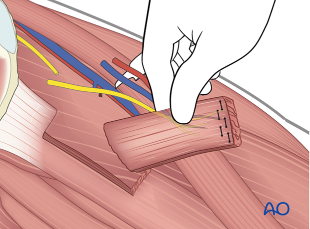 innervated free muscle transfer gracilis