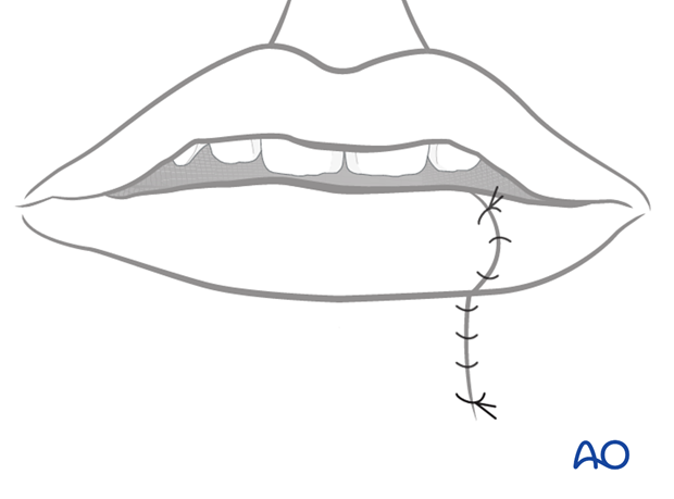 irreversible paralysis mouth lower lip