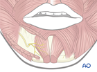 irreversible paralysis mouth lower lip