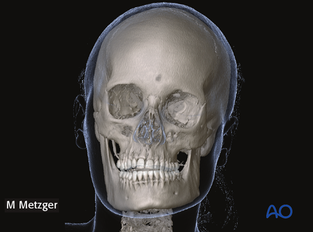 CAS: Asymmetry correction for Laterognathia CAS: Asymmetry correction for Laterognathia