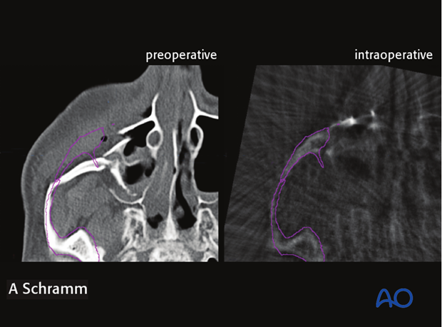 cas virtual planning and intraoperative imaging orif with orbital reconstruction
