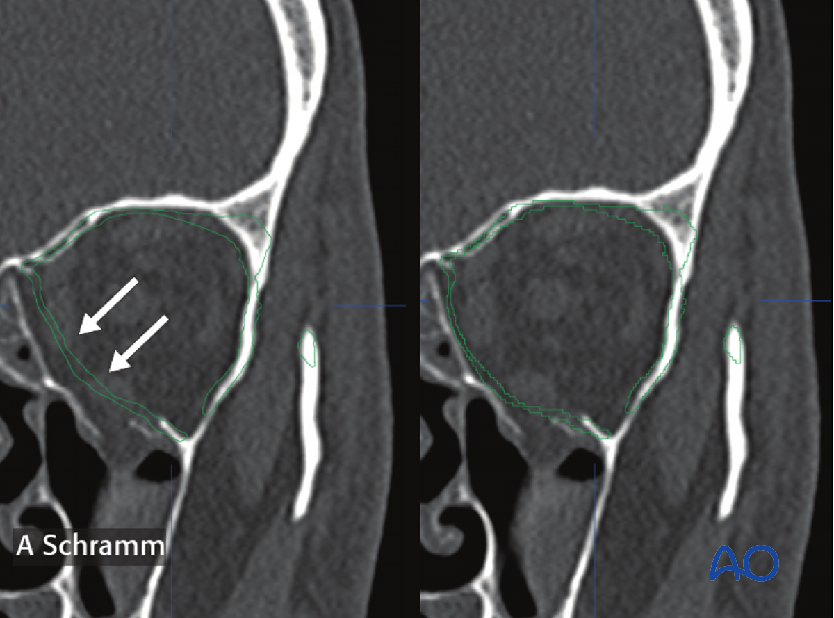 Orbital Reconstruction, CAS: Virtual Planning And Intraoperative ...