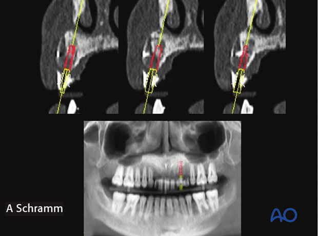 computer assisted dental implant surgery