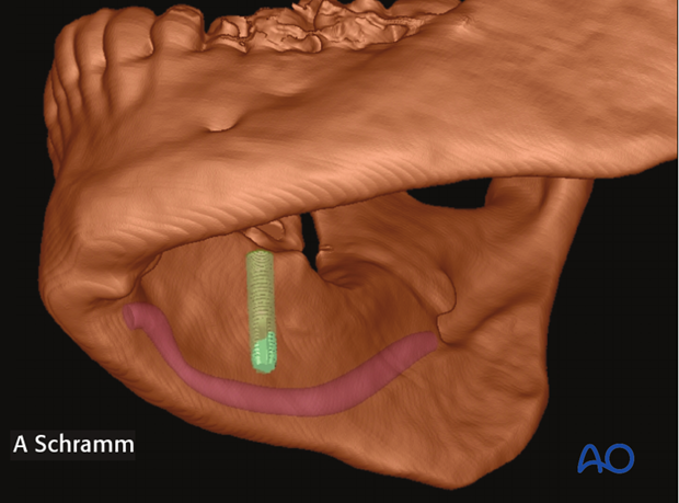 computer assisted dental implant surgery