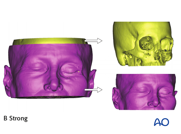 CAS computer assisted surgery