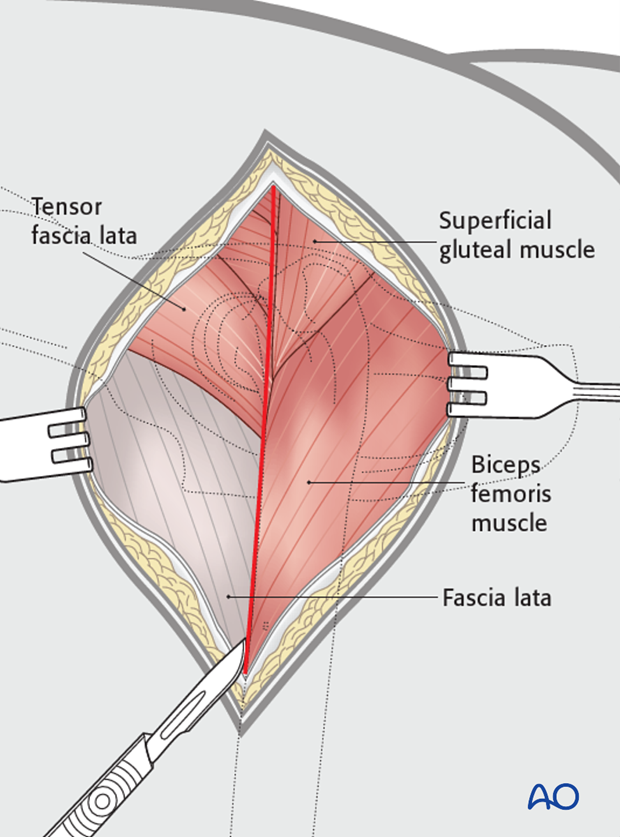 craniolateral approach combined with a dorsal approach