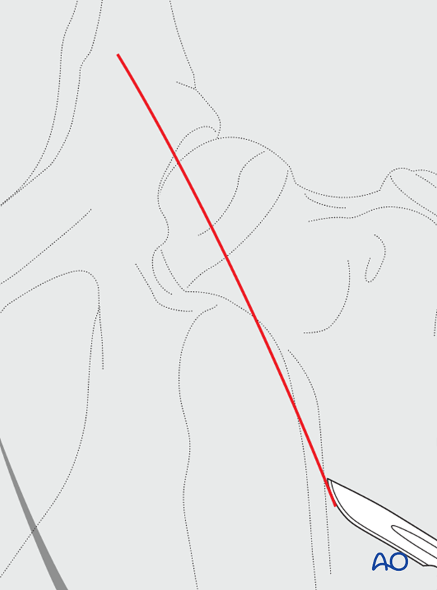 ventral approach