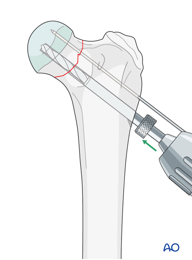 lag screw and k wire