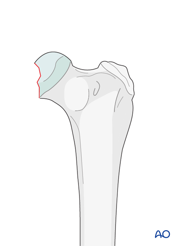 fragment removal