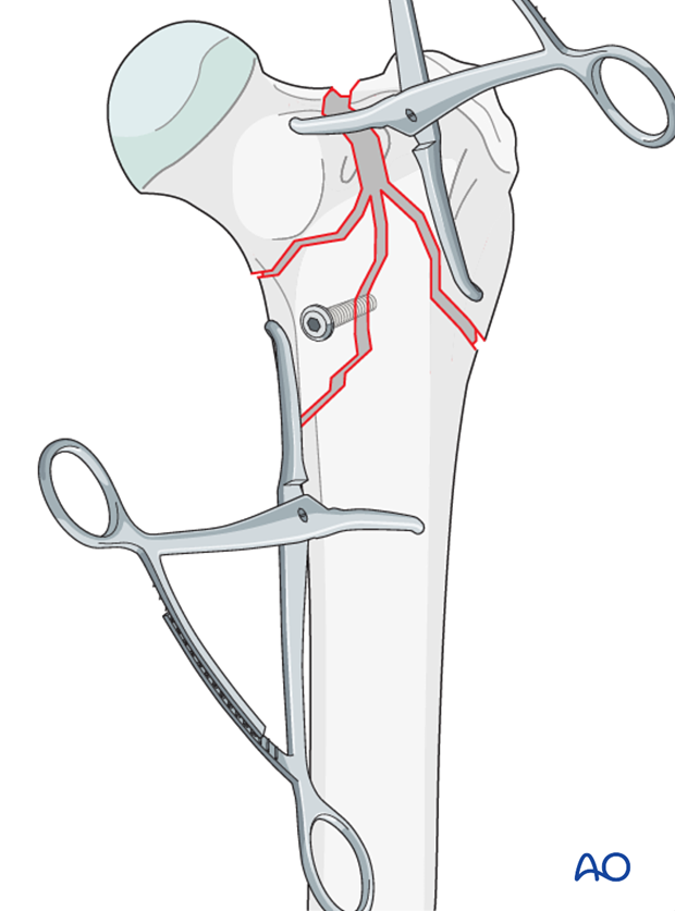 plate and lag screw fixation