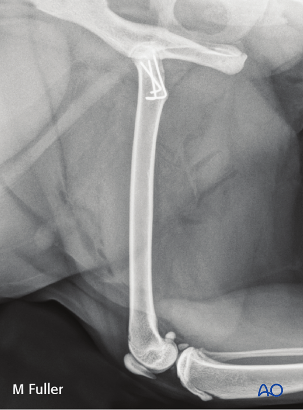 prognosis and complications with proximal femoral fractures