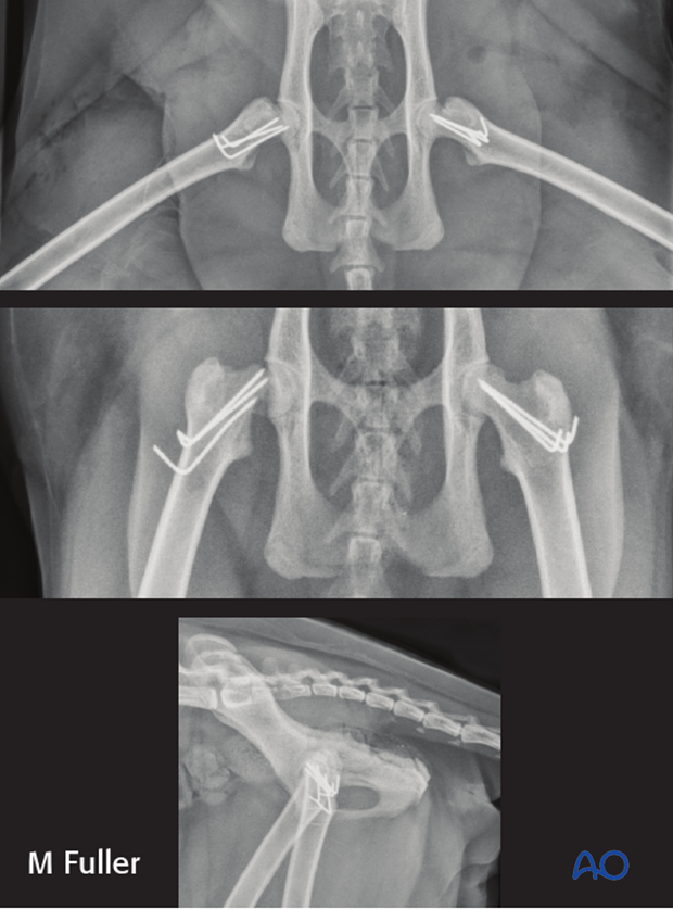 prognosis and complications with proximal femoral fractures