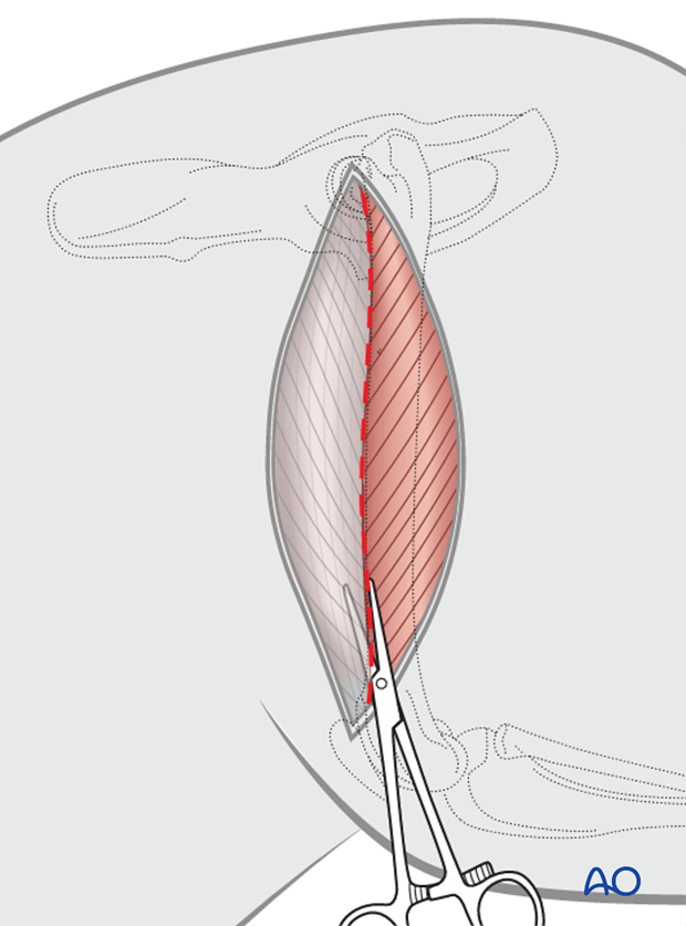 open approach to the femoral shaft