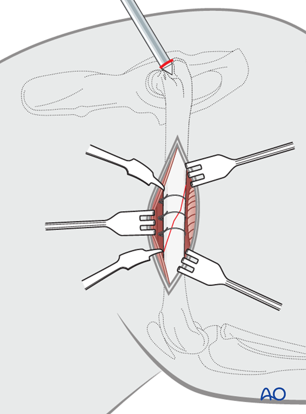 intramedullary pin fixation with cerclage wires