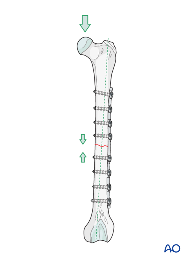 Compression plate for Simple transverse fractures of the femoral diaphysis