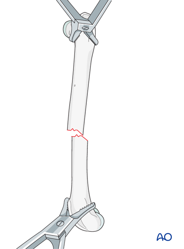 compression plate