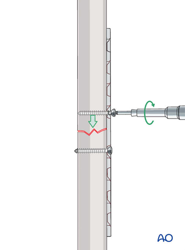 compression plate