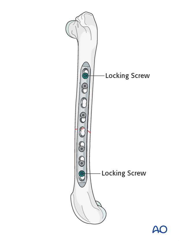 compression plate
