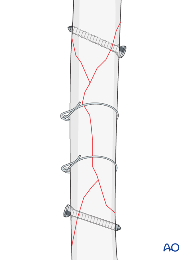 lag screw and neutralization plate