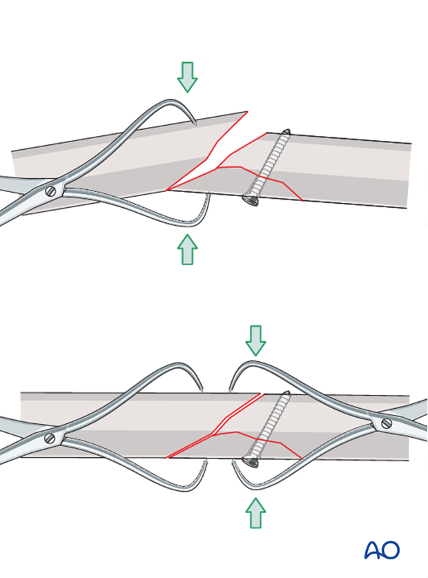 lag screw and neutralization plate