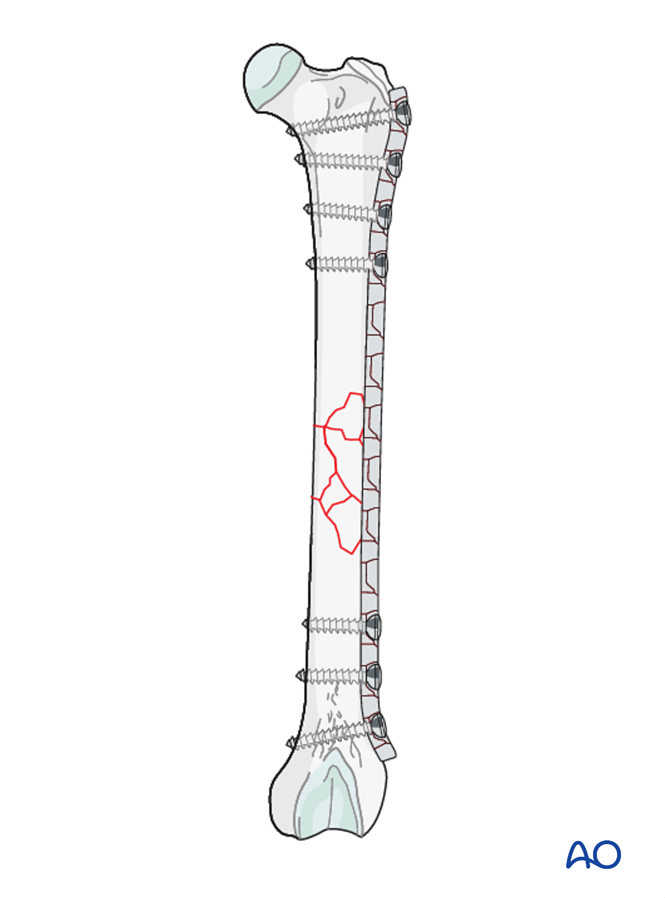 Bridging plate and alternative double plating for Diaphyseal fractures ...