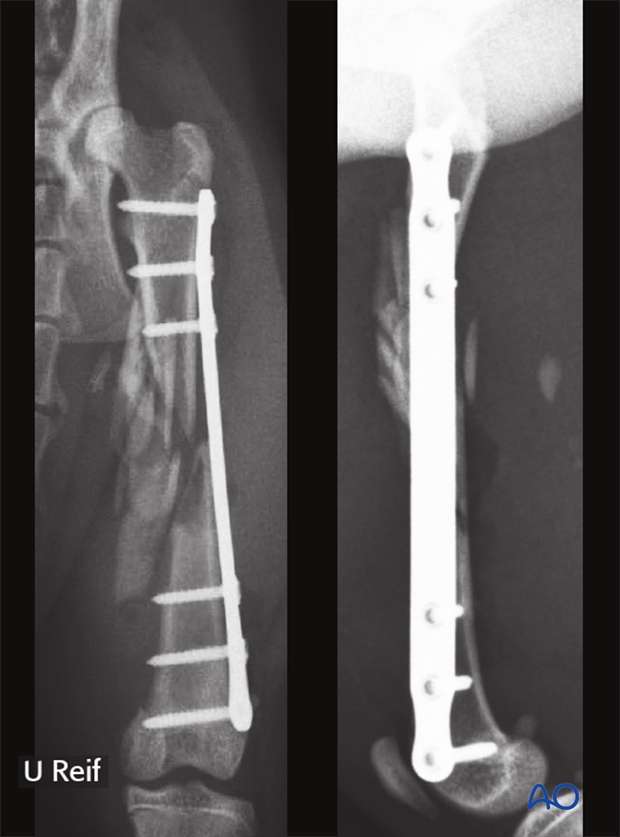 bridging plate and alternative double plating