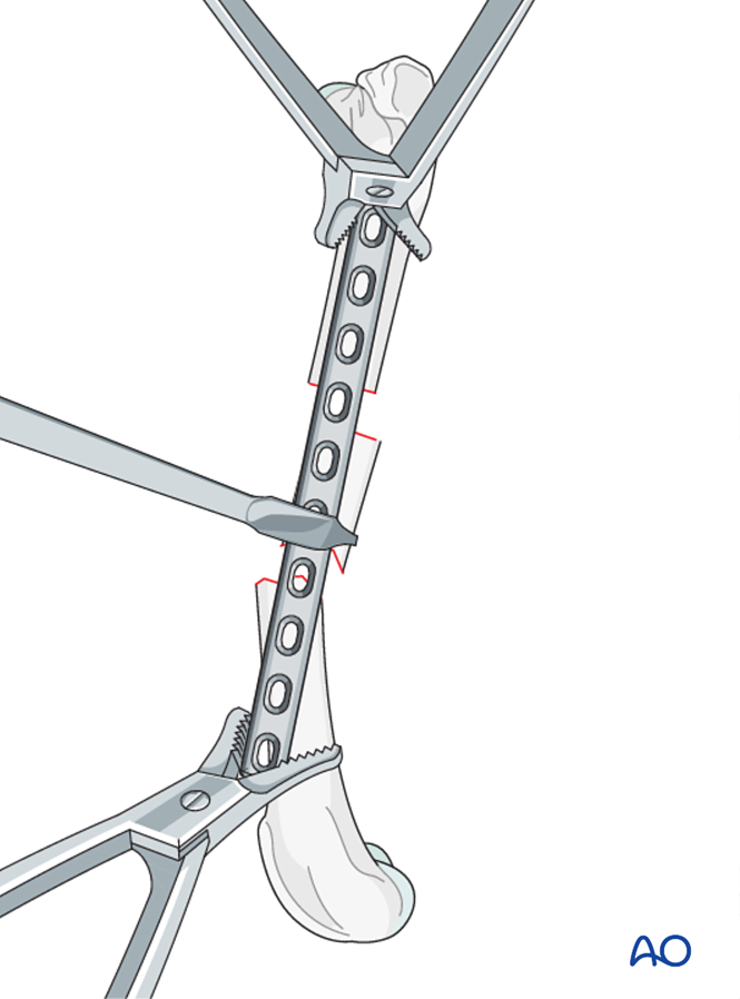 Compression plate for Complex segmental fractures