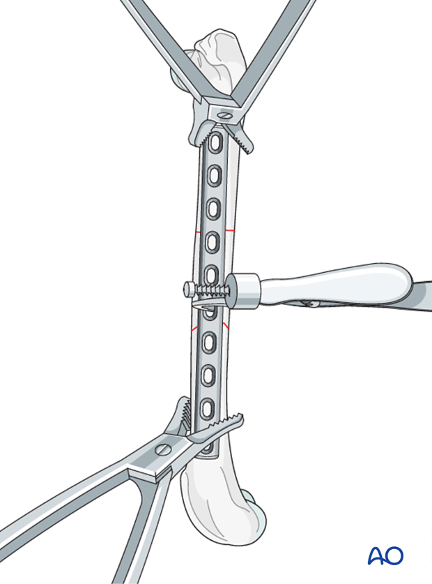 compression plate