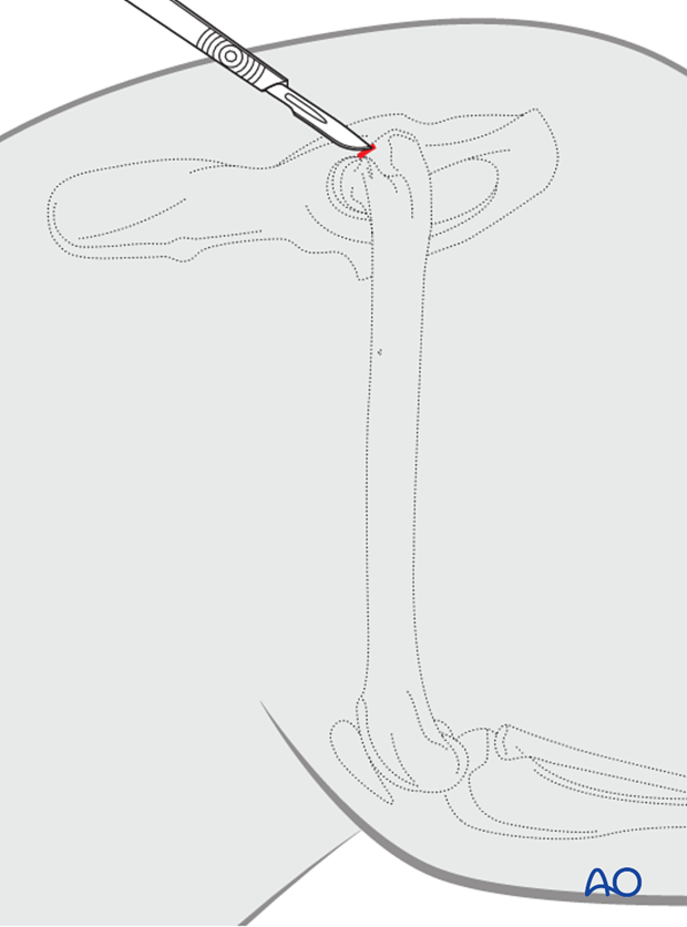 tie in technique