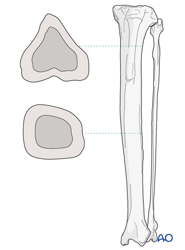 open craniomedial approach and obdnt to the tibial shaft