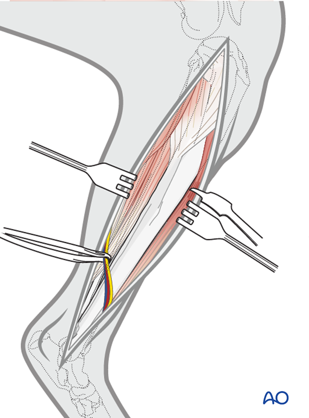 open craniomedial approach and obdnt to the tibial shaft