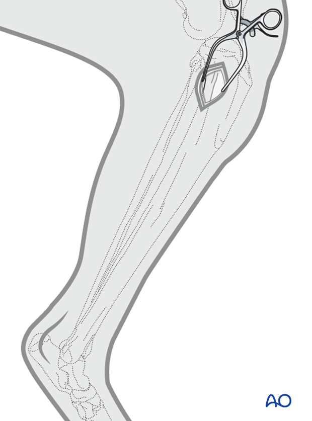 approaches for minimally invasive osteosynthesis mio