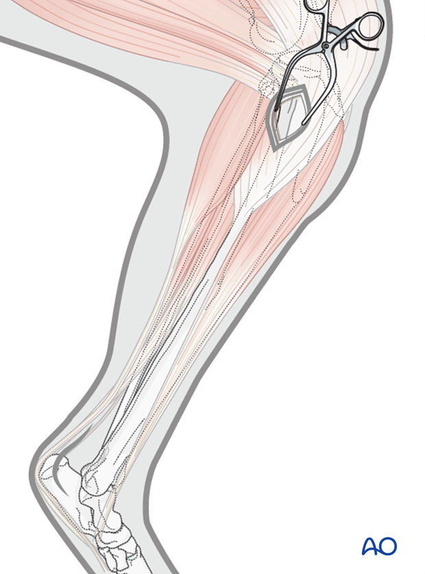 approaches for minimally invasive osteosynthesis mio