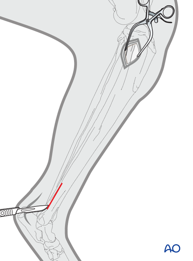 approaches for minimally invasive osteosynthesis mio