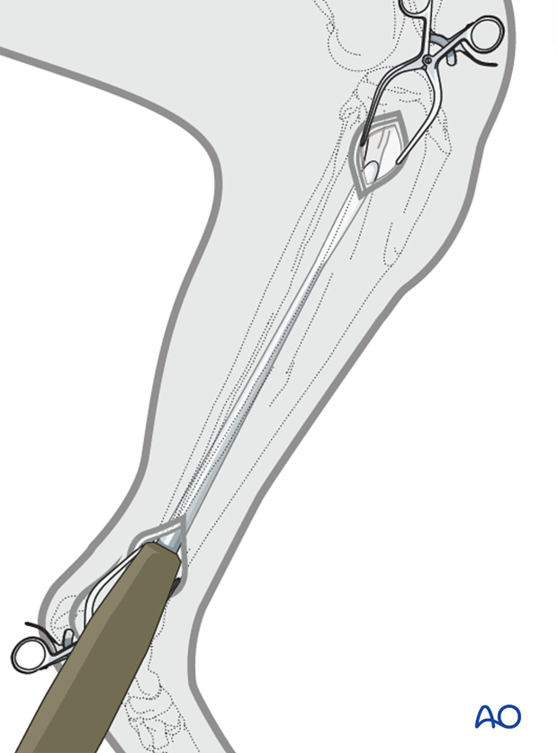 approaches for minimally invasive osteosynthesis mio